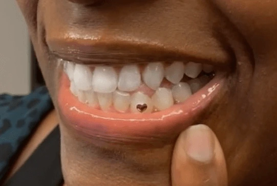 A smiling woman showcasing her decorated tooth with a gem